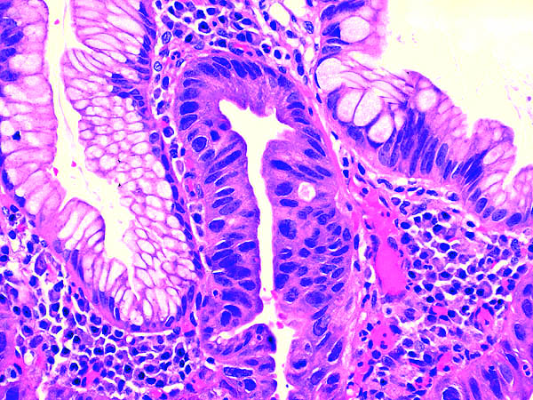 Pathology Outlines Barrett related dysplasia